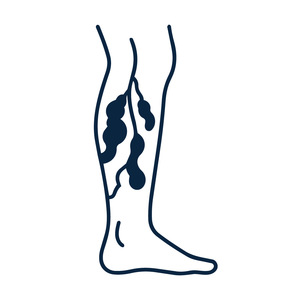 Venas inflamadas o varices